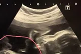 Đi khám thai, người phụ nữ 32 tuổi sốc nặng khi thấy kết quả siêu âm