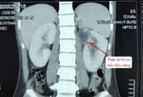 Kỳ lạ cô gái 22 tuổi có 3 quả thận