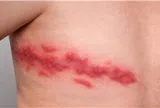 Cảnh báo nguy cơ gia tăng bệnh zona ở người có bệnh mạn tính