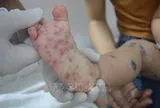 Tăng cường công tác truyền thông, kiểm soát bệnh tay chân miệng