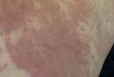 Rước bệnh sau khi đi bơi giải nhiệt mùa nóng, chuyên gia chỉ rõ "thủ phạm"