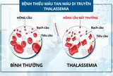 Bệnh tan máu bẩm sinh: Bệnh di truyền lặn nhưng phổ biến nhất ở Việt Nam và thế giới