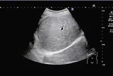 Nam sinh 15 tuổi "gan trắng xoá", bác sĩ chỉ thẳng do 2 món khoái khẩu "vạn người mê”