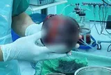 Đau bụng tưởng nhẹ, người đàn ông "sốc nặng" khi phát hiện thứ "đáng sợ" to bằng quả dưa lưới