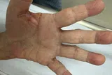 Một gia đình bị loài ký sinh trùng tưởng đã "biến mất" từ lâu tấn công