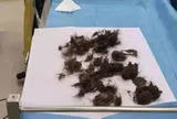 Thiếu nữ 19 tuổi hói đầu, đau bụng, bác sĩ lấy ra thứ "đáng sợ" trong dạ dày