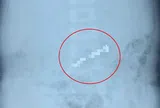 Bé gái hơn 2 tuổi đau bụng dữ dội, bác sĩ gắp ra thứ "đáng sợ" bên trong