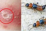 Kiến ba khoang "vào mùa", cẩn trọng dễ nhầm với zona thần kinh