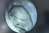 Người phụ nữ ngứa tai đi khám, bác sĩ phát hiện thứ bất ngờ bên trong