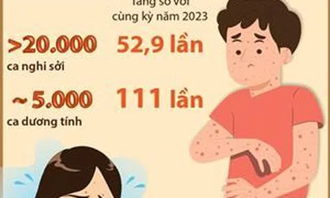 Số ca mắc sởi cao hơn cùng kỳ 111 lần, đã có 5 ca tử vong