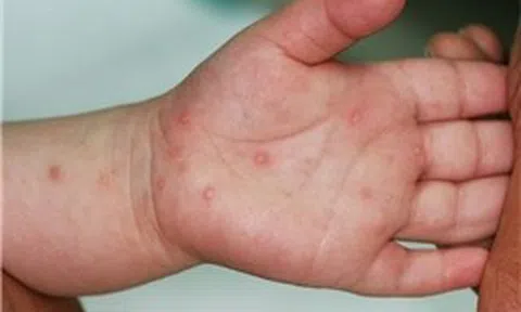 Bệnh tay chân miệng tại TP Hồ Chí Minh đang có dấu hiệu gia tăng trở lại