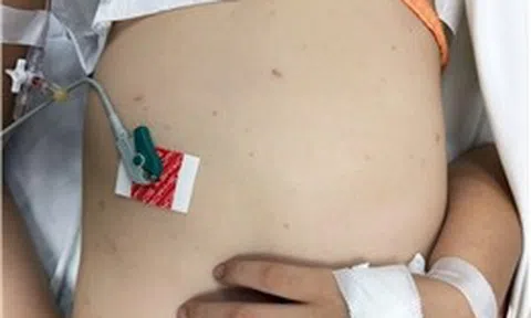 Cảnh báo gia tăng bệnh não mô cầu ở khu vực phía Nam