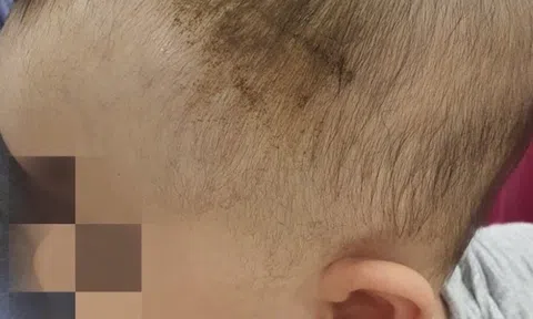 Bé 7 tuổi chấn thương nặng sau cú ngã tưởng vô hại