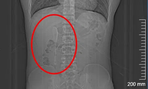 Đau bụng đi khám, bác sĩ sốc nặng khi thấy thứ trong bụng người đàn ông