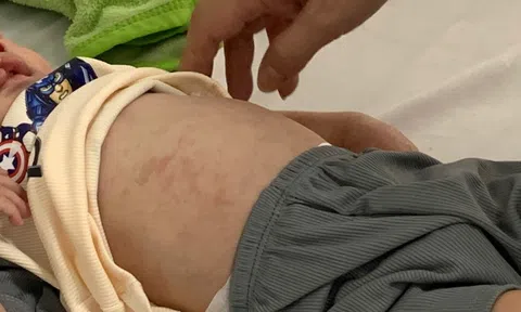 Rà soát đối tượng tiêm vaccine sởi