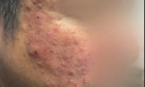 Tưởng mụn trứng cá, người đàn ông đi khám phát hiện "thủ phạm thầm lặng" gây bệnh