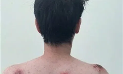 Bệnh giang mai gia tăng trở lại, cảnh báo nguy cơ ở nhóm quan hệ đồng giới