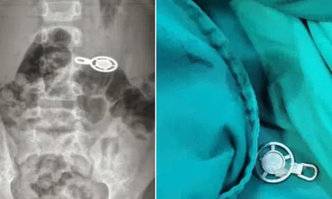 Nuốt móc khóa khi ngủ trưa, bé 4 tuổi phải nhập viện cấp cứu