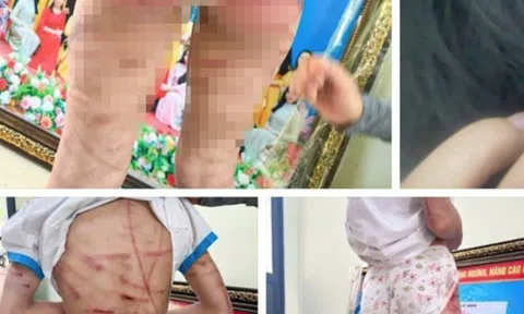 Vụ bé gái lớp 5 bị cha dượng bạo hành: Công an thông tin chính thức