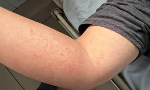 Bất kỳ ai cũng có thể mắc sốt xuất huyết và nguy cơ bệnh nặng