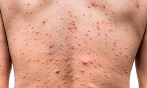 Giám sát, phát hiện sớm ổ dịch thủy đậu, không để lây lan trong cộng đồng