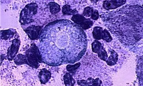 Tiểu bang Ấn Độ đối mặt với sự gia tăng số ca bệnh hiếm 'amip ăn não người'