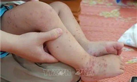 Vĩnh Long: Đảm bảo xử lý ổ dịch tay chân miệng trong vòng 48 giờ