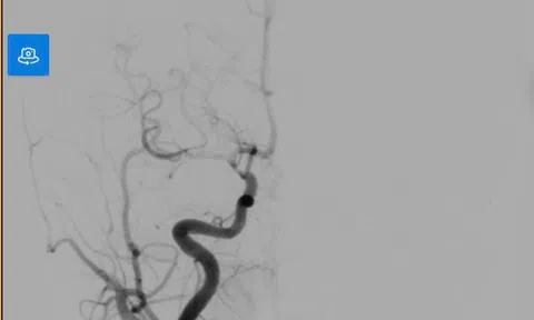 Cảnh báo đột quỵ não ở trẻ: Ca bệnh đánh thức sự chủ quan