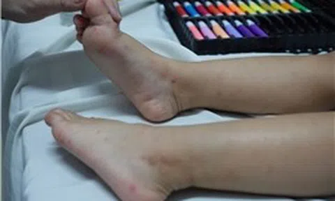 TP Hồ Chí Minh có 35.440 ca mắc tay chân miệng