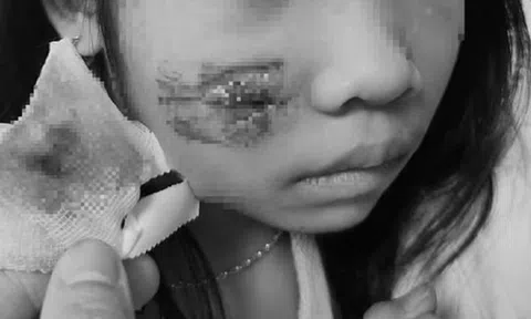 Đang chơi ở sân nhà, bé 8 tuổi bị khỉ tấn công, vết thương phức tạp