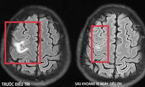 Cơn co giật bất thường hé lộ “vị khách lạ” ký sinh trong não