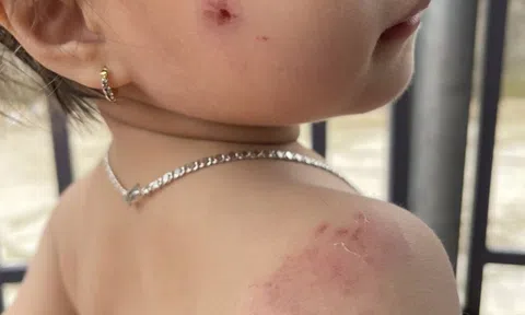 Nhà trường báo cáo gì về vụ bé gái 2 tuổi bị nhiều vết cắn khi học ở lớp?