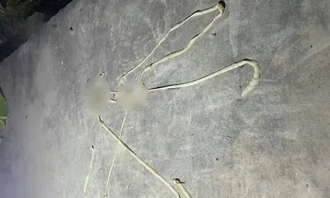 Bị rối loạn tiêu hóa, người đàn ông phát hiện "vật thể lạ" dài gần 10m