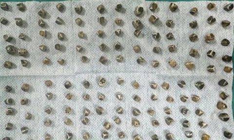 Đau bụng đi khám, người phụ nữ 40 tuổi sốc khi bác sĩ gắp ra thứ "đáng sợ" bên trong