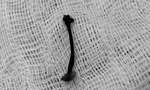 Bé trai hơn 2 tuổi mũi rỉ máu kéo dài, bác sĩ gắp ra thứ "đáng sợ" bên trong