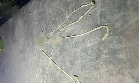 Bị rối loạn tiêu hóa, người đàn ông phát hiện "vật thể lạ" dài gần 10m