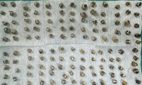 Đau bụng đi khám, người phụ nữ 40 tuổi sốc khi bác sĩ gắp ra thứ "đáng sợ" bên trong