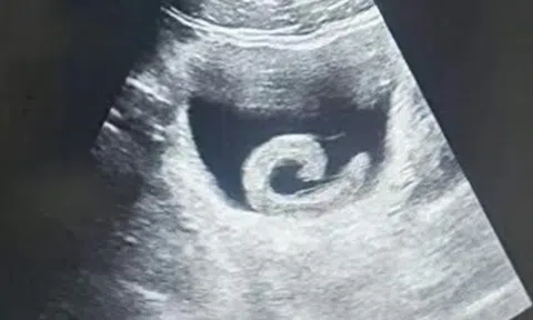 Đi siêu âm, người đàn ông sốc nặng khi thấy con vật "bơi" trong bụng mình
