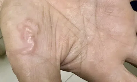 Thường xuyên ăn món "vạn người mê", cô gái trẻ sốc khi biết nhiễm 4 loại ký sinh trùng