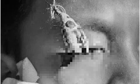 Bé trai 12 tuổi đau mắt dữ dội, bác sĩ gắp ra thứ "đáng sợ" bên trong