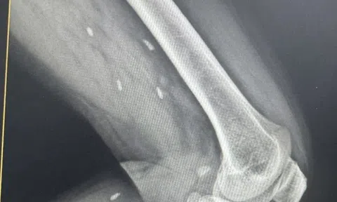 Thói quen nhiều người Việt mê mẩn khiến sán “làm tổ” dưới da mà không hay biết