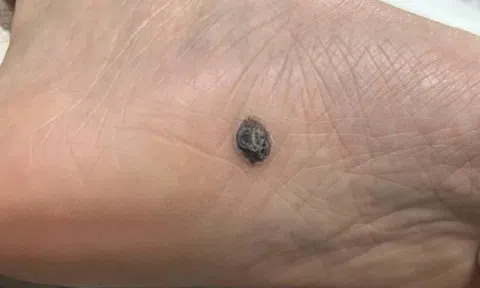 5 dấu hiệu nốt ruồi có thể là ung thư da, dấu hiệu số 1 dễ bị bỏ qua