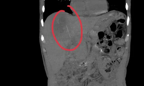 Người đàn ông đau bụng kéo dài, bác sĩ sốc khi phát hiện bí mật bên trong