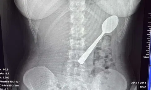 Đang ăn sữa chua, người phụ nữ nuốt chiếc thìa dài 17cm vào bụng