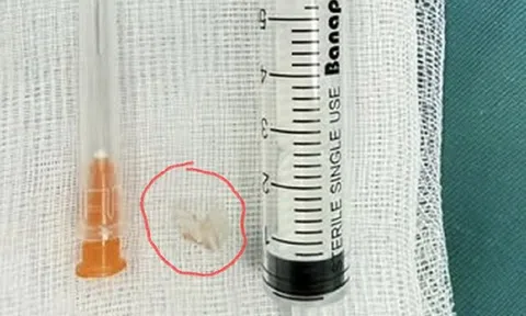 Bé trai 7 tuổi xẹp phổi trái, bác sĩ gắp ra thứ "đáng sợ" bên trong