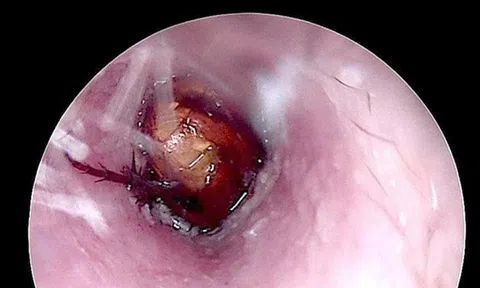 Cháu bé đau tai dữ dội, bác sĩ sốc ngang phát hiện bí mật "đáng sợ" bên trong