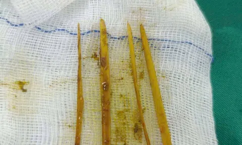 Cô gái 26 tuổi đau bụng dữ dội, bác sĩ “chết lặng” khi phát hiện thứ bên trong