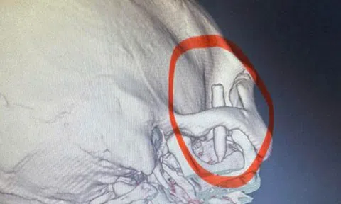 Chàng trai đau thái dương suốt 13 năm, bác sĩ phát hiện ra bí mật "đáng sợ" bên trong