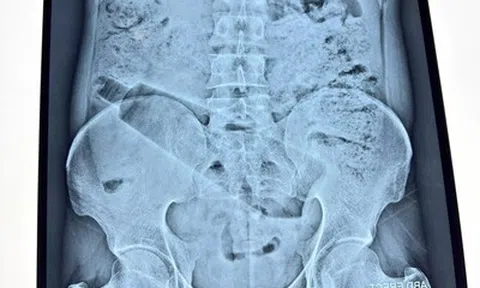 Người đàn ông đau bụng 36 tiếng, bác sĩ phát hiện "bí mật" bên trong