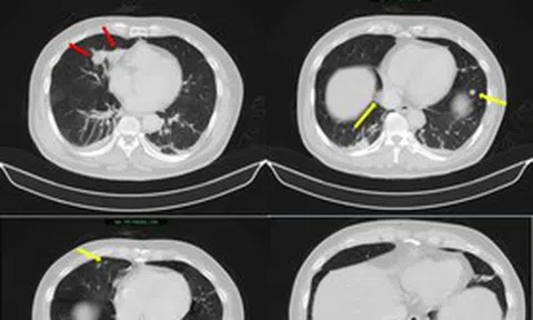 Người đàn ông 63 tuổi sốc nặng khi phát hiện mắc hai bệnh ung thư cùng lúc